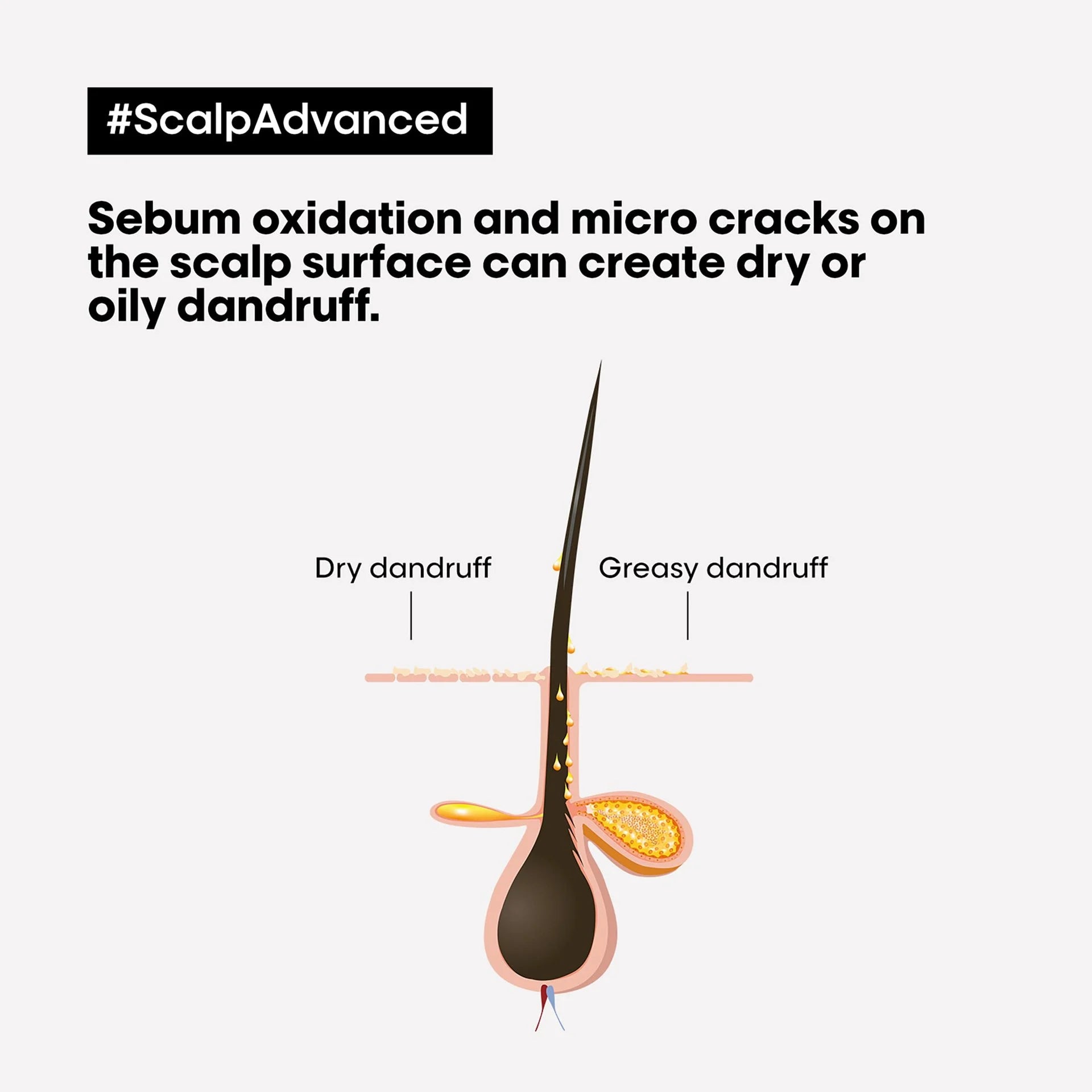 L'Oreal Professionnel Serie Expert Scalp Dandruff Advance Shampoo (300ml)